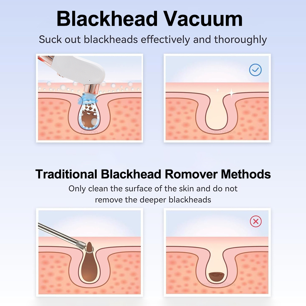 Electric Blackhead Remover Vac - đánh giá và giá Pore Vacuum