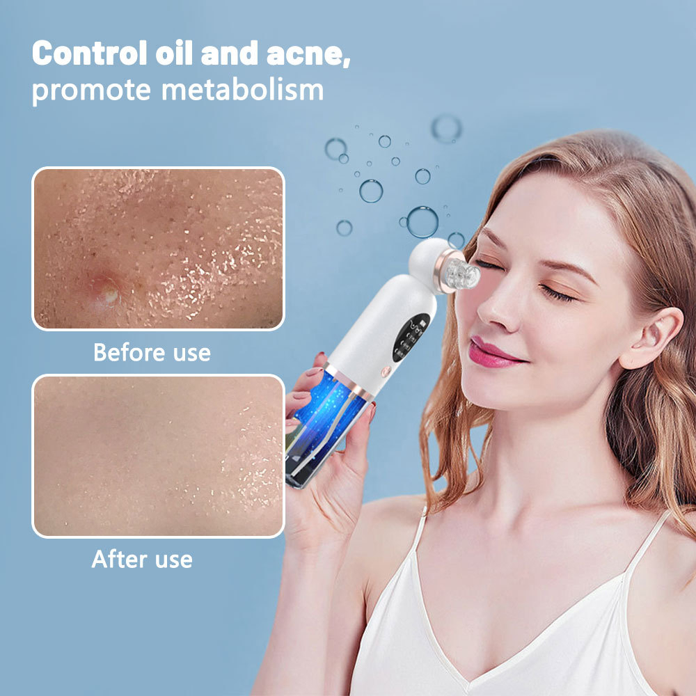 Blackhead Remover Pore Vacuum  - đánh giá và giá Pore Vacuum